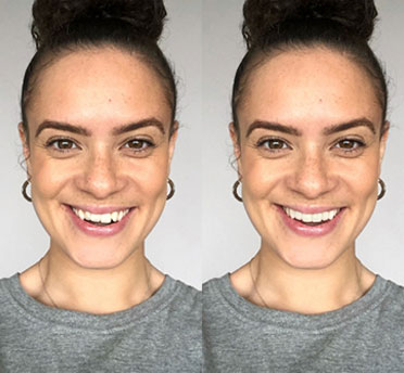 Images by Invisalign®