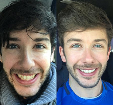 Images by Invisalign®