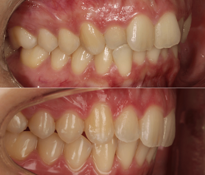 invisalign before after
