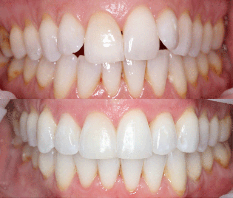 invisalign before after