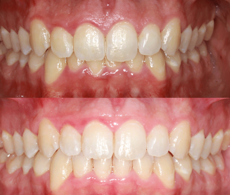 invisalign before after