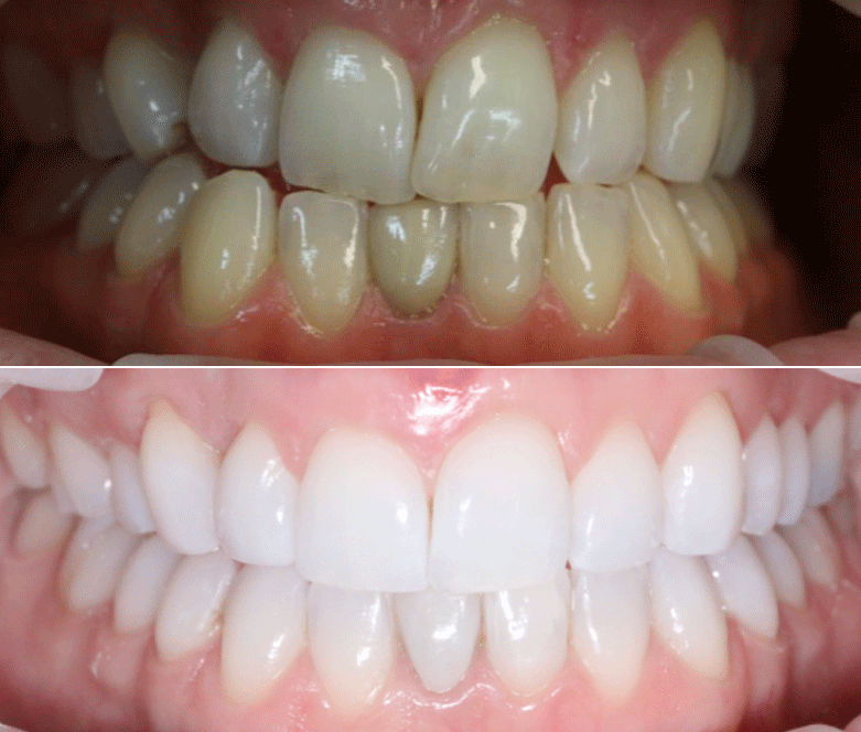 invisalign before after