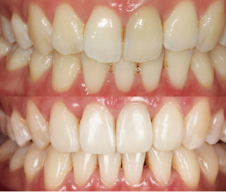 invisalign before after