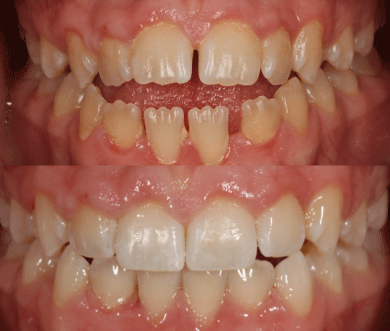 invisalign before after