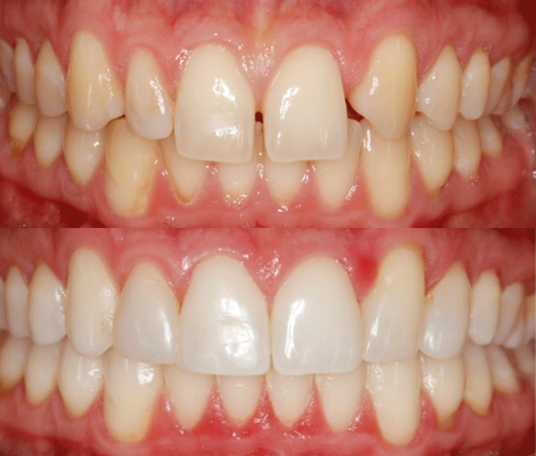 invisalign before after