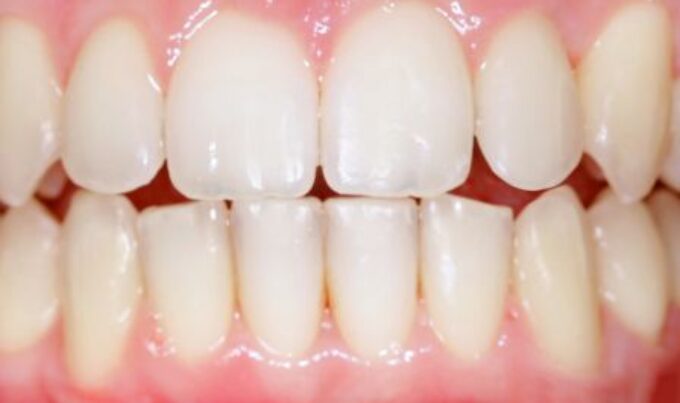 Case 6 After-min digimax2pt0